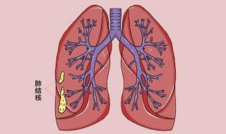 肺结核有什么症状 肺结核病人的典型症状